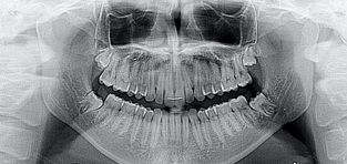 Teenage patient with partially developed roots