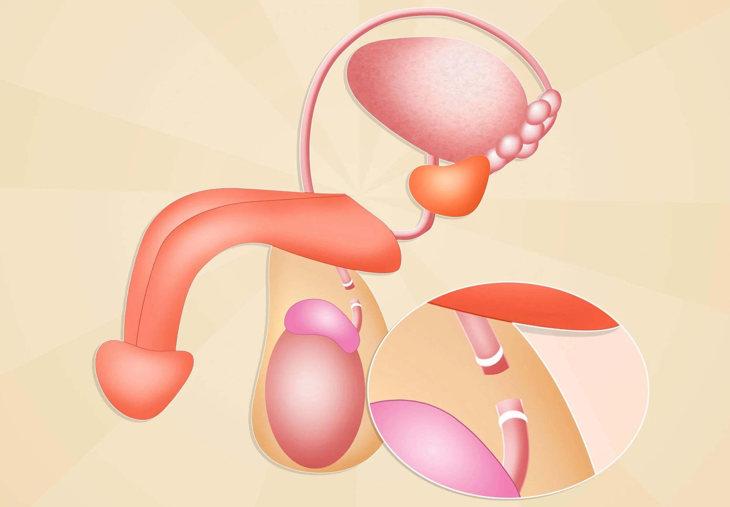 vasectomy-and-vasectomy-reversals