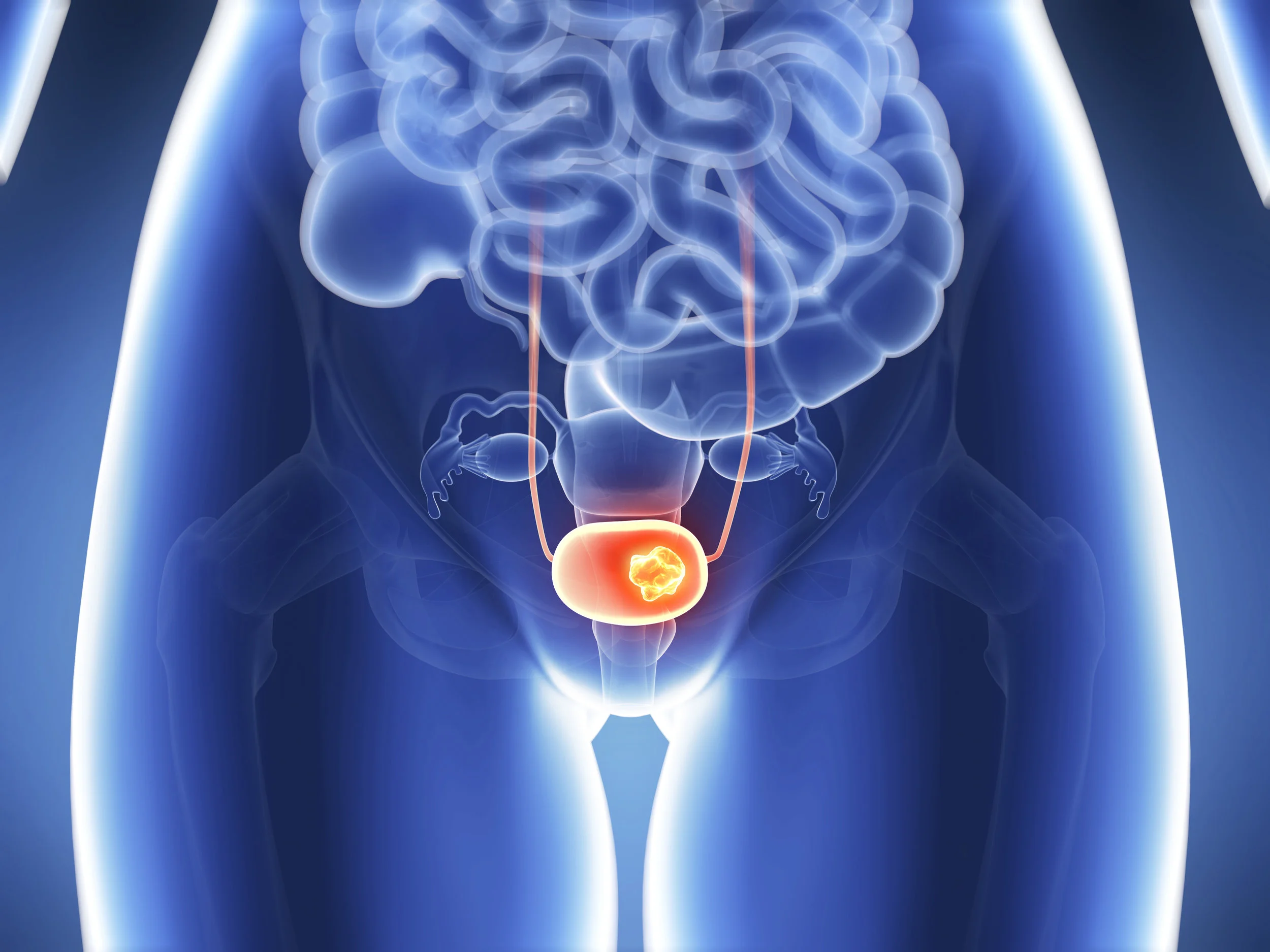 bladder-cancer