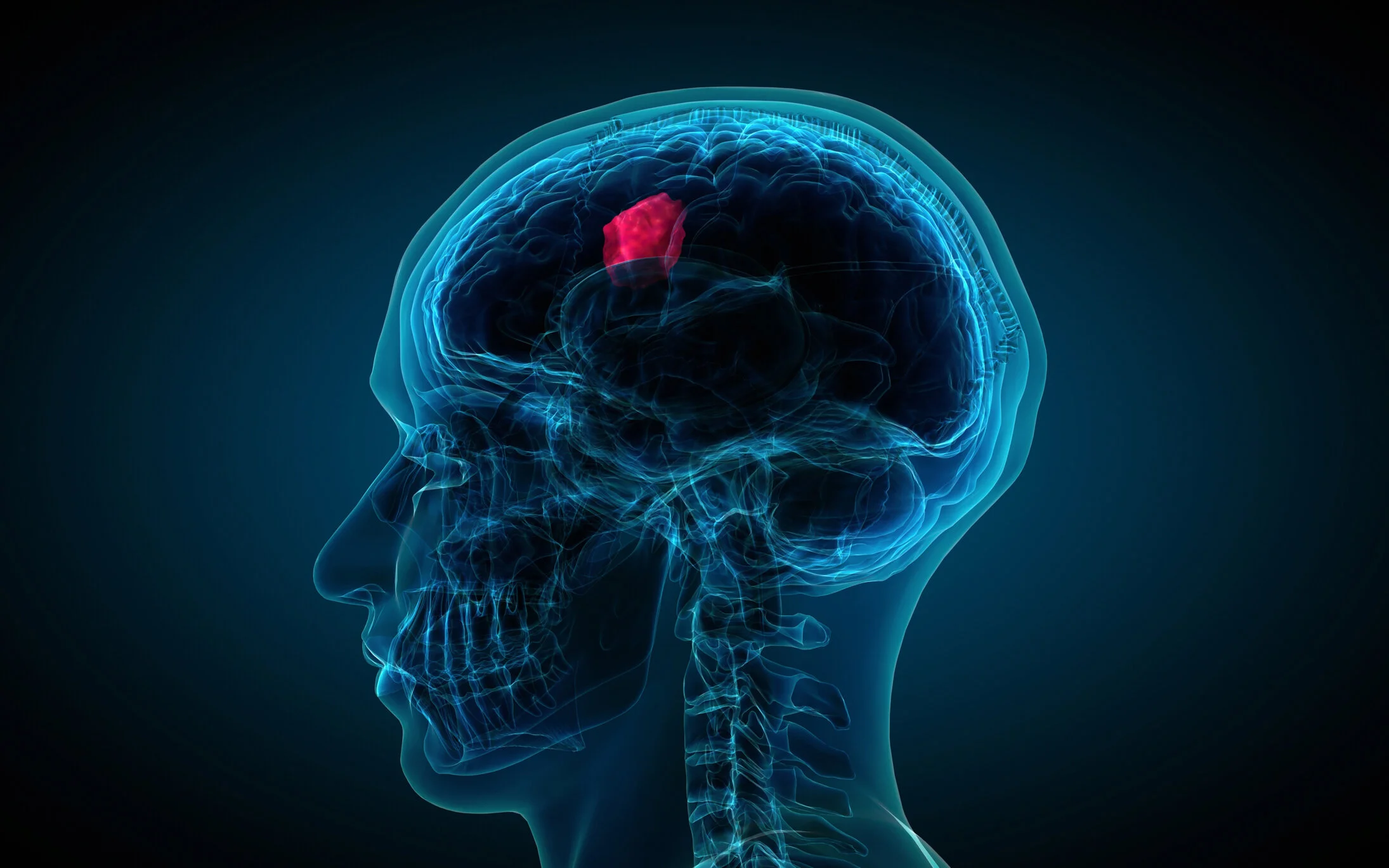 Brain tumor and falls