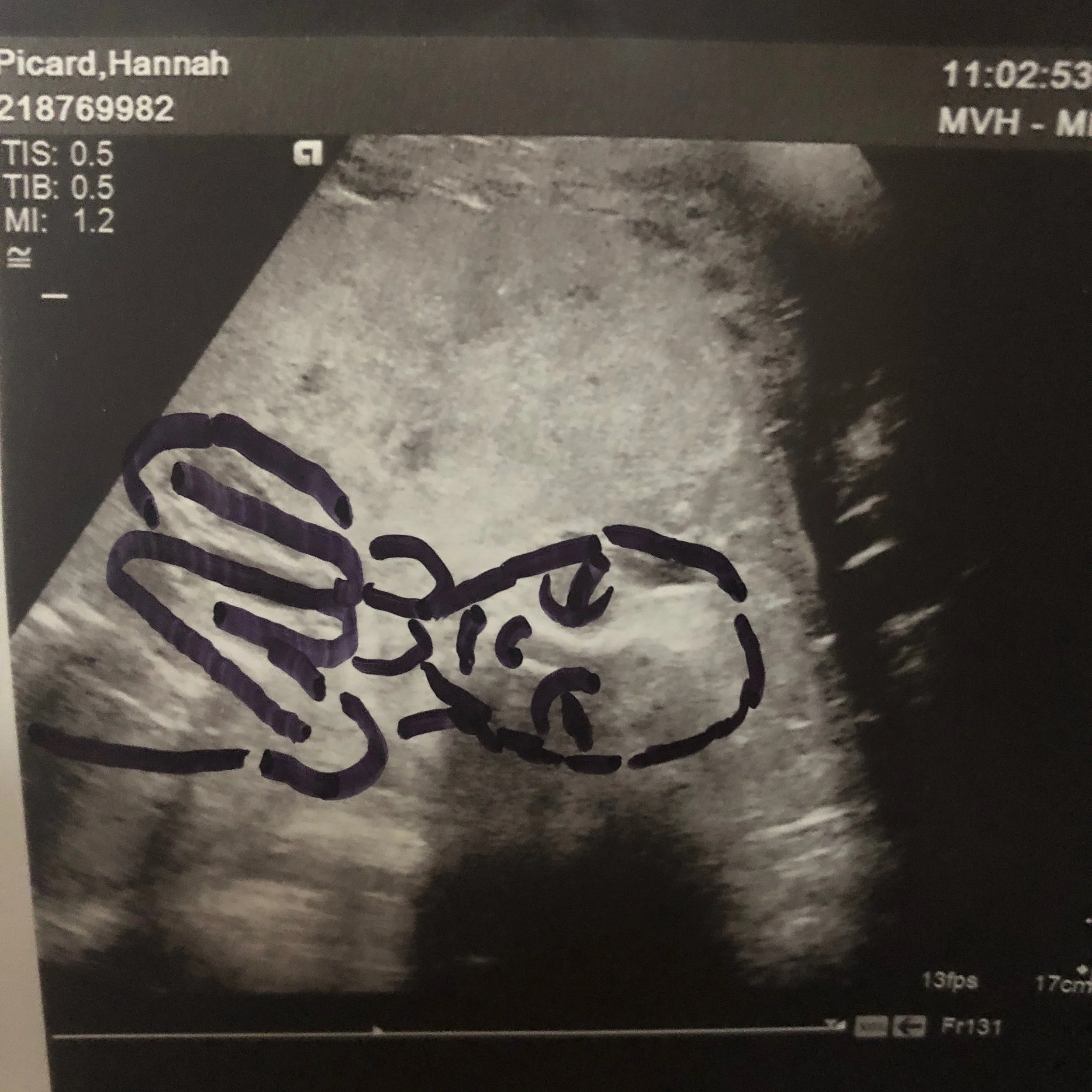 Jonny helped me out with a visual of what I was really seeing on the ultrasound. If Asher had fluid this is what we would see… Without fluid we only see a little eye and a little outline.