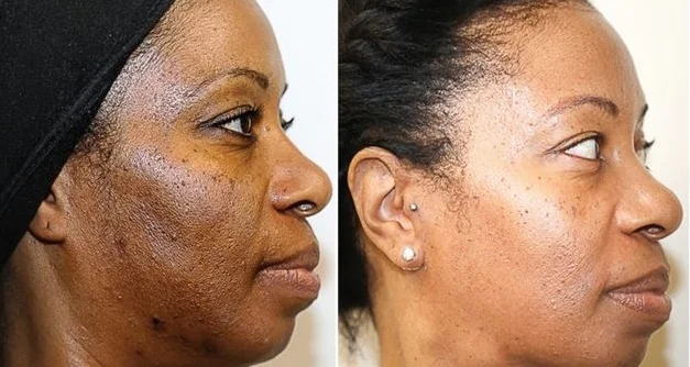 best chemical peel for acne scars and large pores