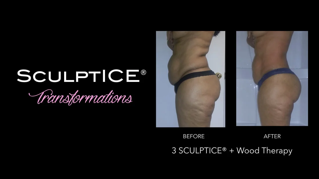 Body Contouring FAQ — Hidden Gem Luxury Body Contouring FAQ — Hidden Gem Luxury
