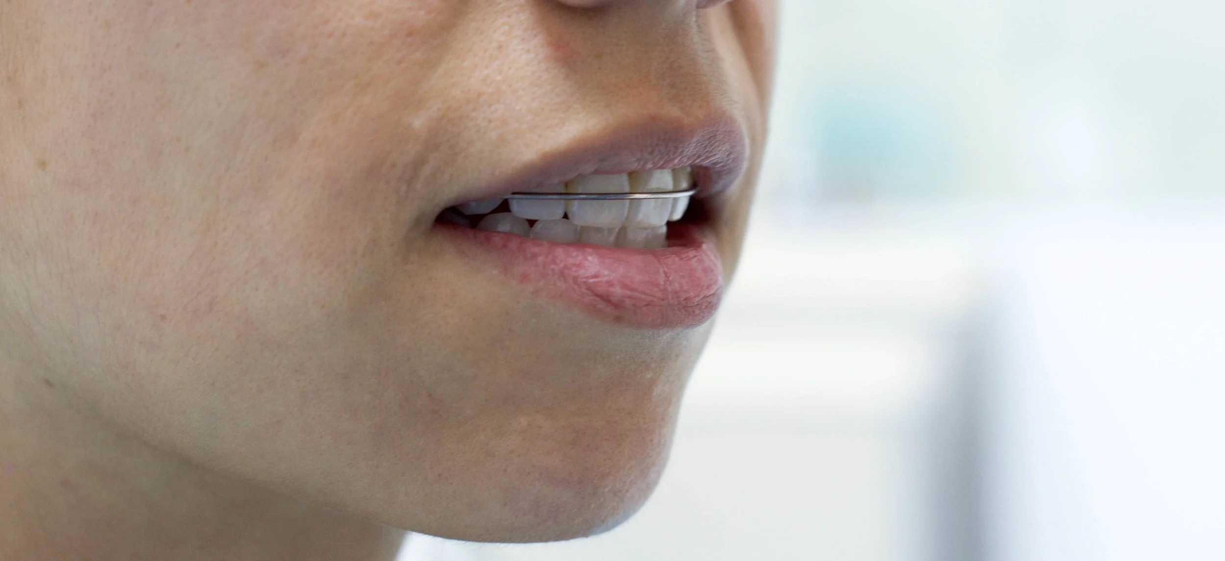 retenedores dentales