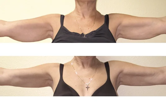 In 5-weeks, after (10) Body Sculpt treatments: • Toned and lifted underarms