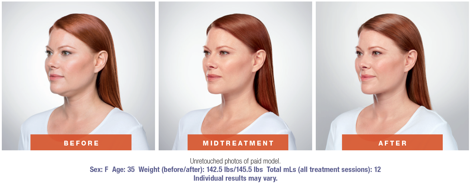 Melt Away That Double Chin with Belkyra™