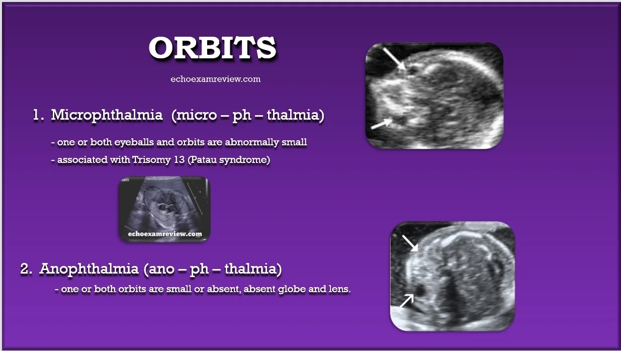 Microphthalmia and Anophthalmia