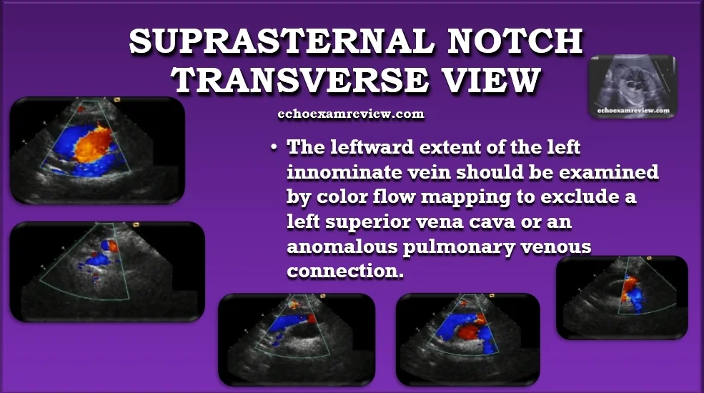 Suprasternal Transverse Aortic Arch View
