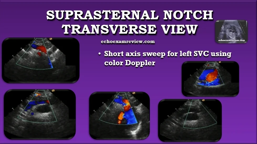 Suprasternal Transverse Aortic Arch View