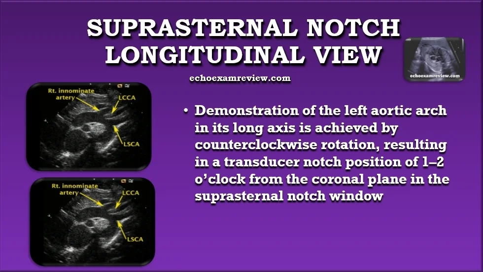 Suprasternal Longitudinal Aortic Arch View