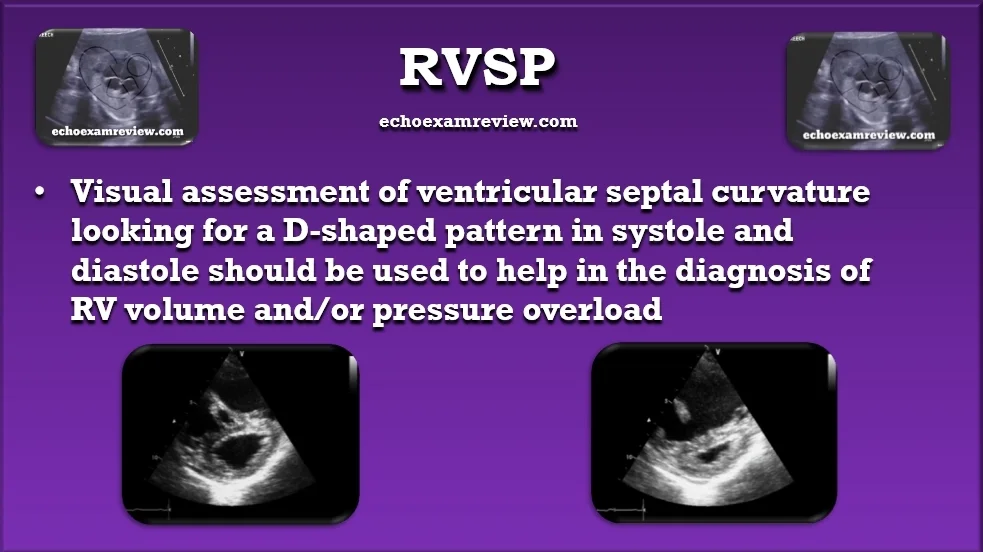 D-Shaped Left Ventricle