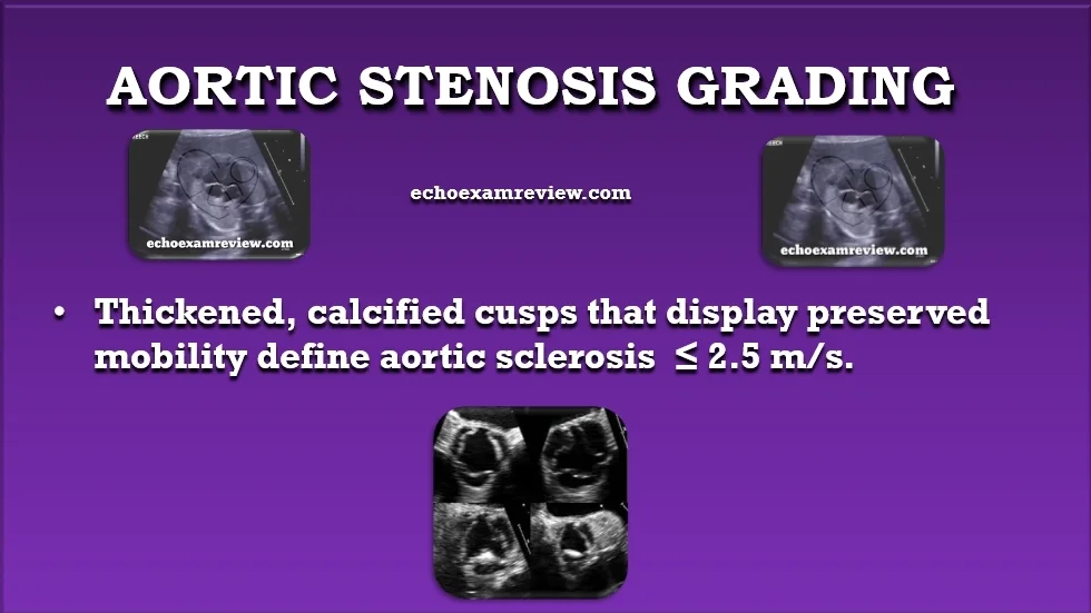 Aortic Sclerosis