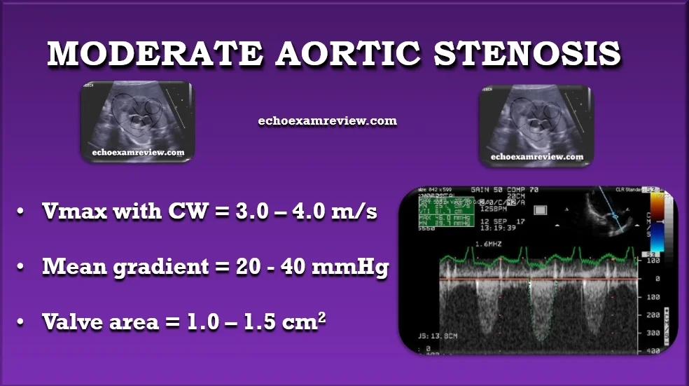 Moderate Aortic Stenosis