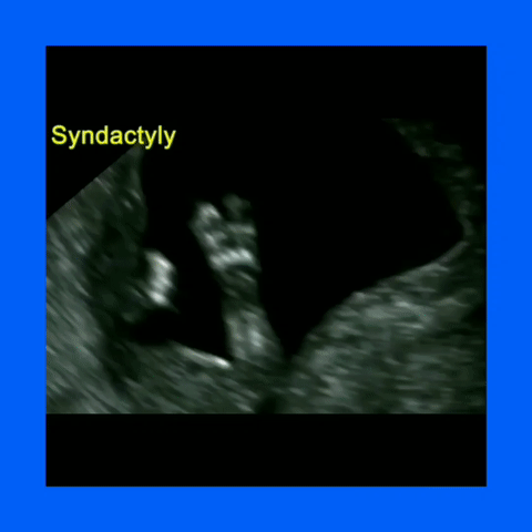 Ob Gyn Ultrasound Apert Syndrome