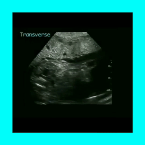Ob Gyn Ultrasound Beckwith-Weidemann Syndrome