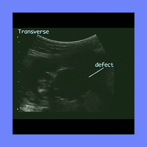 Ob Gyn Ultrasound Meckel-Gruber Syndrome