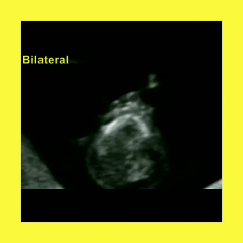 Ob Gyn Ultrasound Patau Syndrome (Trisomy 13) Cleft lip/Palate