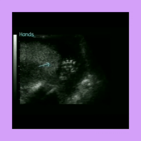 Ob Gyn Ultrasound Patau Syndrome Polydactyly