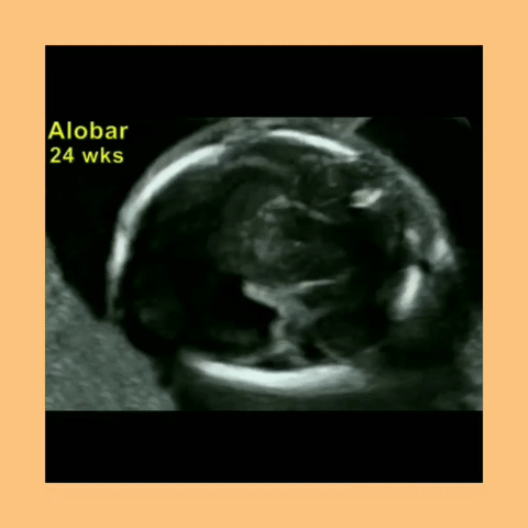 Holoprosencephaly continued Other Patau sonographic findings include IUGR, VSD, Omphalocele, Cystic Renal Dysplasia, Truncus Arteriosus, Agenesis of Corpus Callosum and Microphalmia.