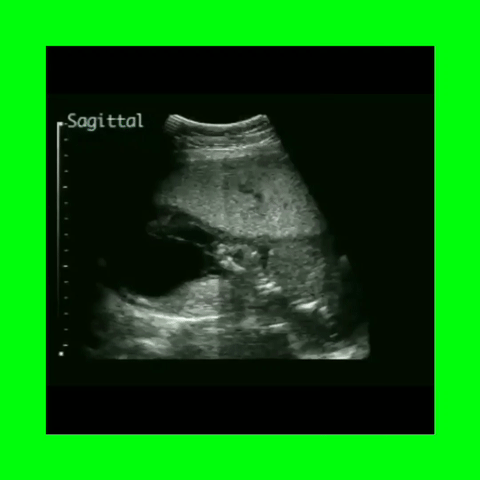 Turner's Syndrome Cystic Hygroma