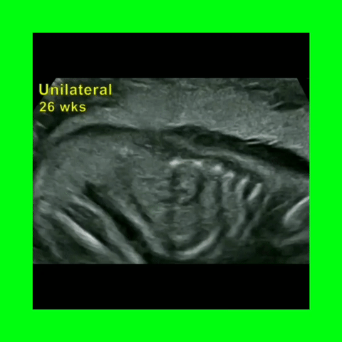 Turner's Syndrome Renal Agenesis