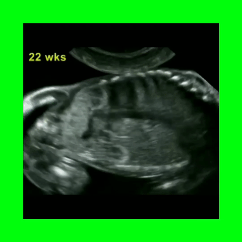 Turner's Syndrome Horseshoe Kidney