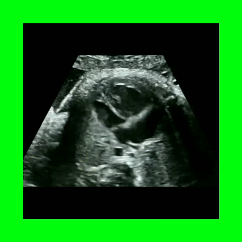 Turner's Syndrome Coarctation