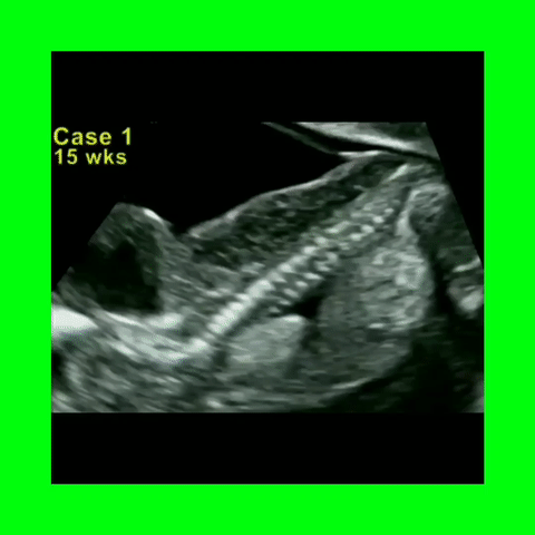 Turner's Syndrome Hydrops