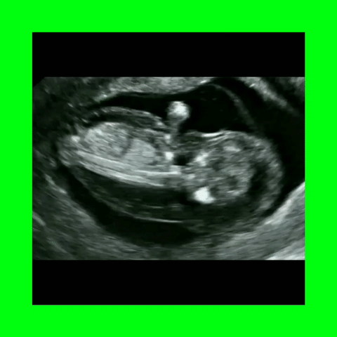 Turner's Syndrome Hydrops More Will Be Posted Soon!😀
