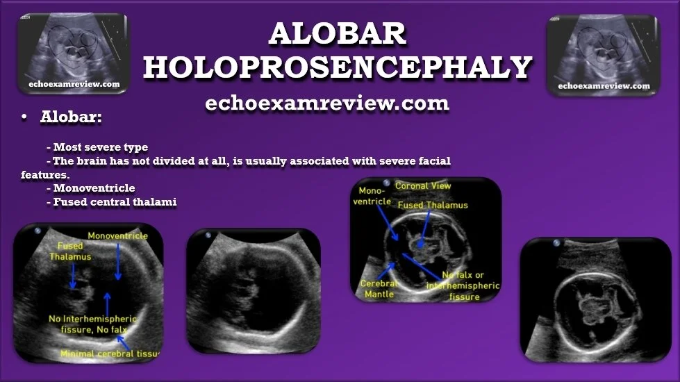 Alobar Holoprosencephaly