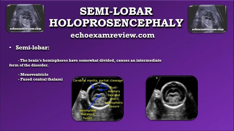 Semi-Lobar Holoprosencephaly