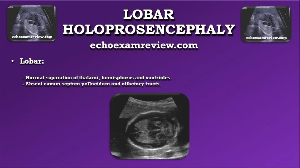 Lobar Holoprosencephaly