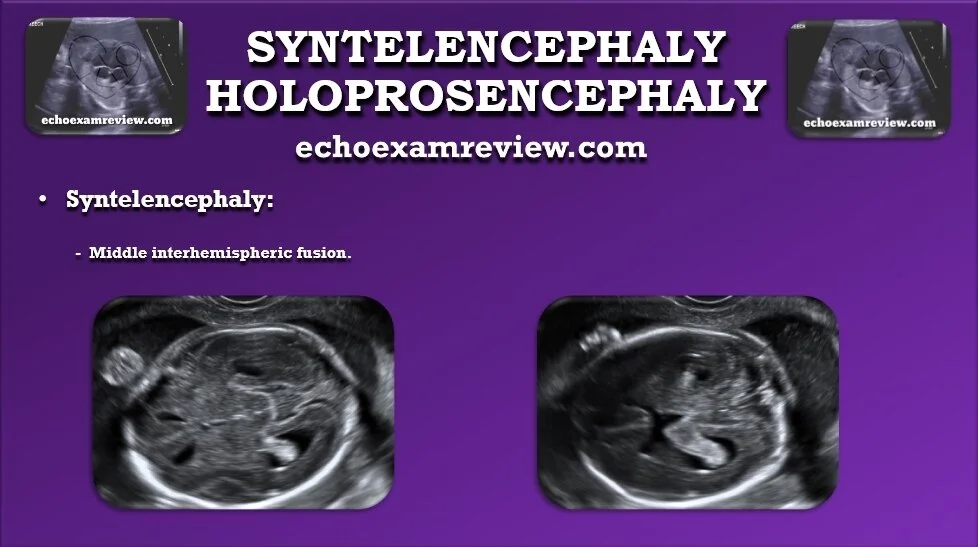 Syntelencephaly Holoprosencephaly