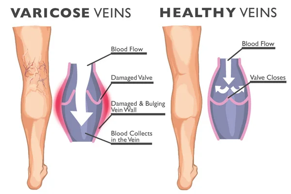 Varicose_Veins_diagram.jpg