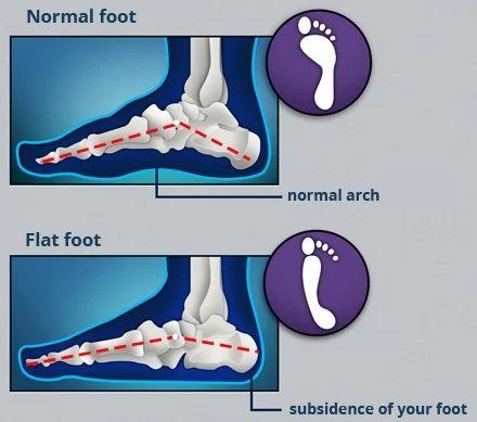 flat-feet-e1421868057520.jpg