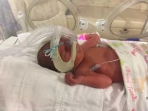 With fewer complications, Rheya was able to leave NICU earlier than her twin sister.