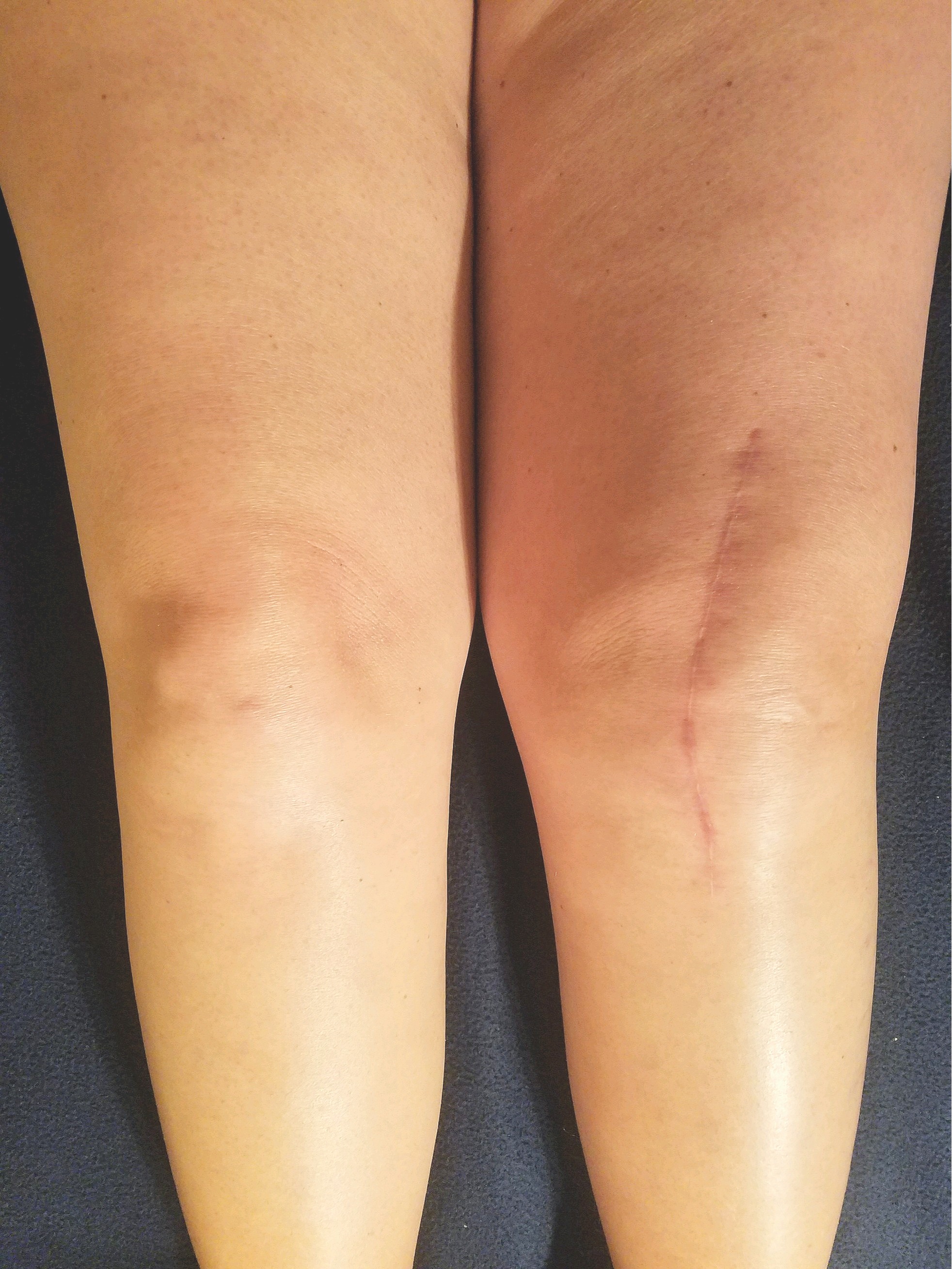 Cicatrice typiqque après un remplacement du genou