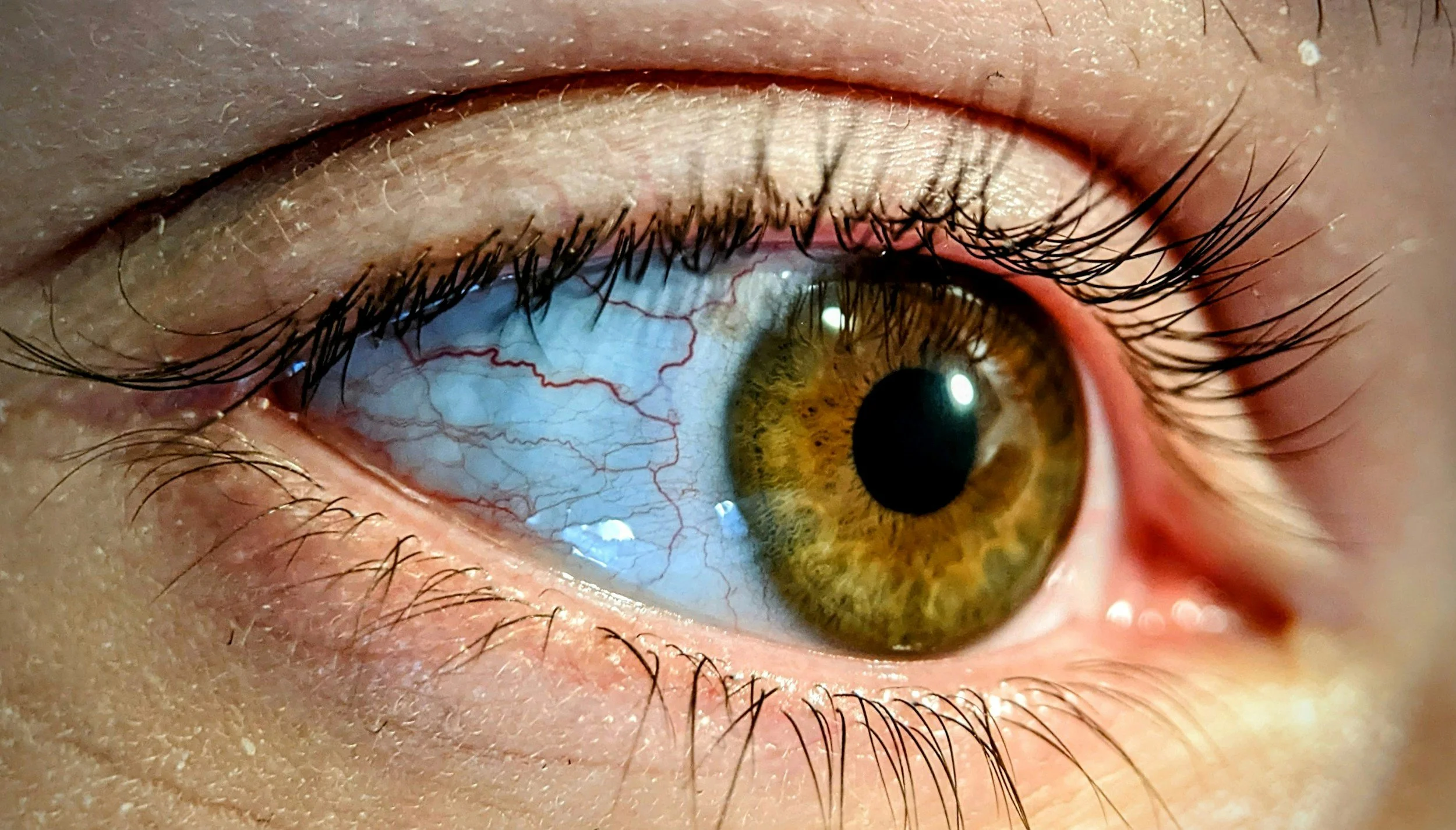 Image of a biliary iris with part of the sclera showing.