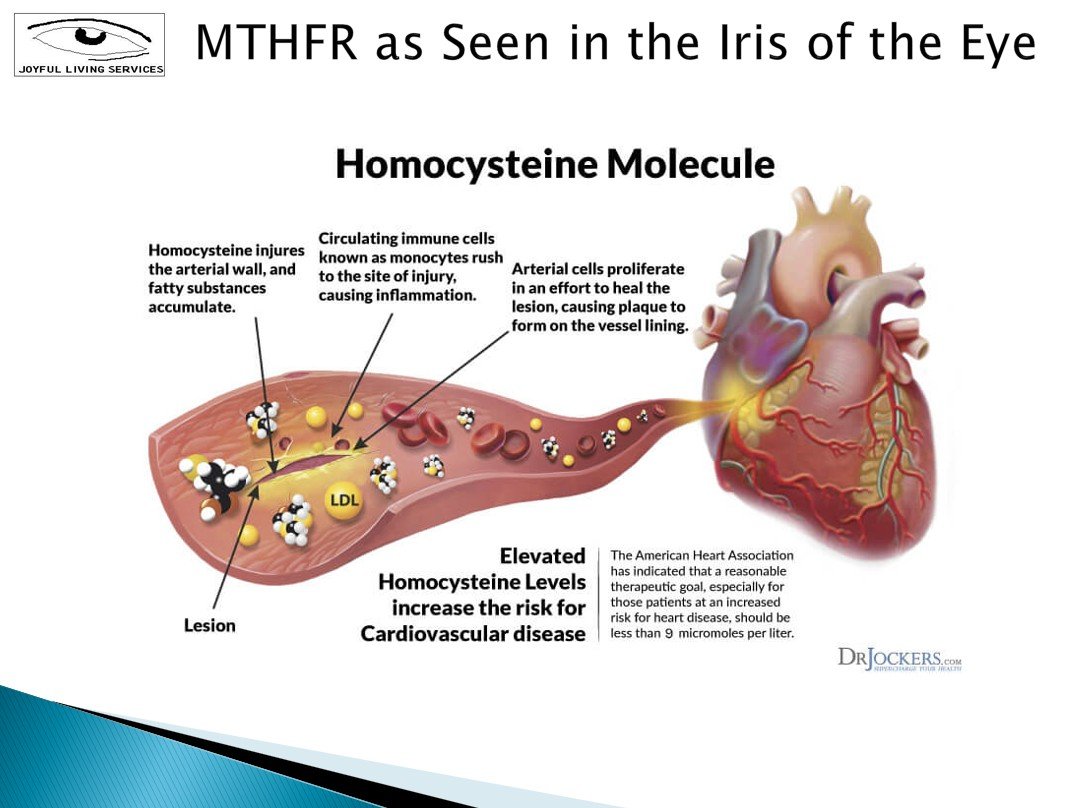 MTHFR Gene Variants: Exploring Connections with Iris Pigmentation