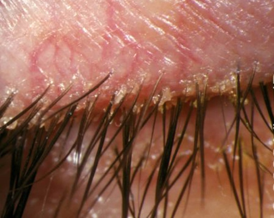 The Eye and Gut Connection