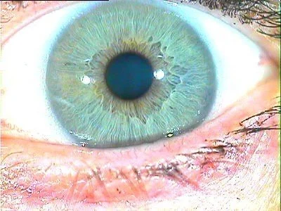 Iris example illustrating a soft, indistinct outer edge where the iris meets the sclera.