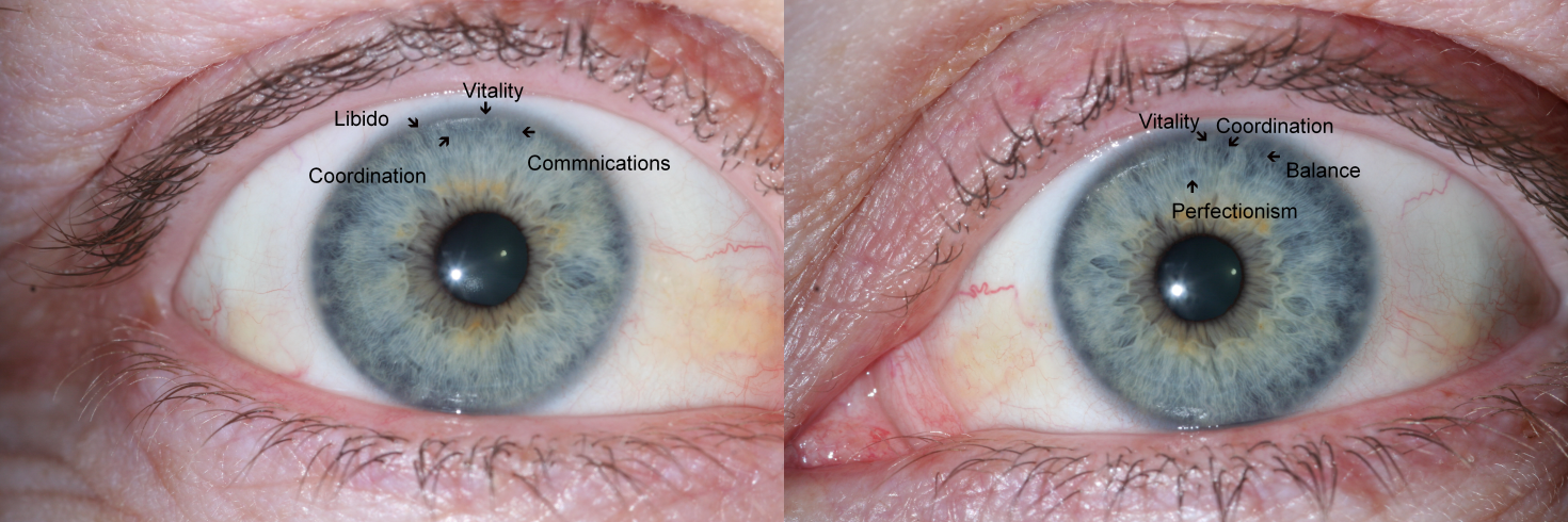 Iris examples illustrating markings in the area identified as the libido zone in iridology.