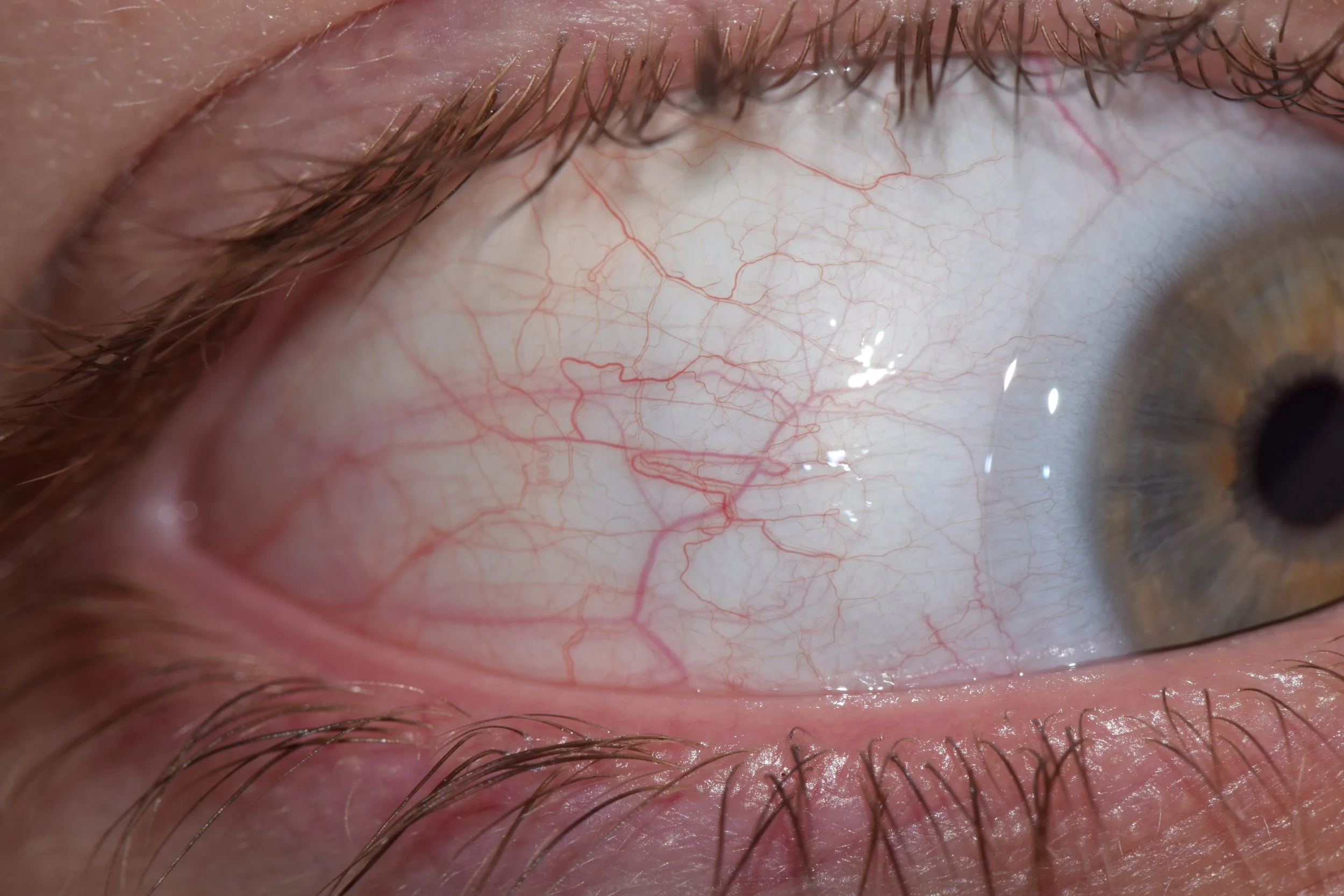 Sclera signs in a right eye