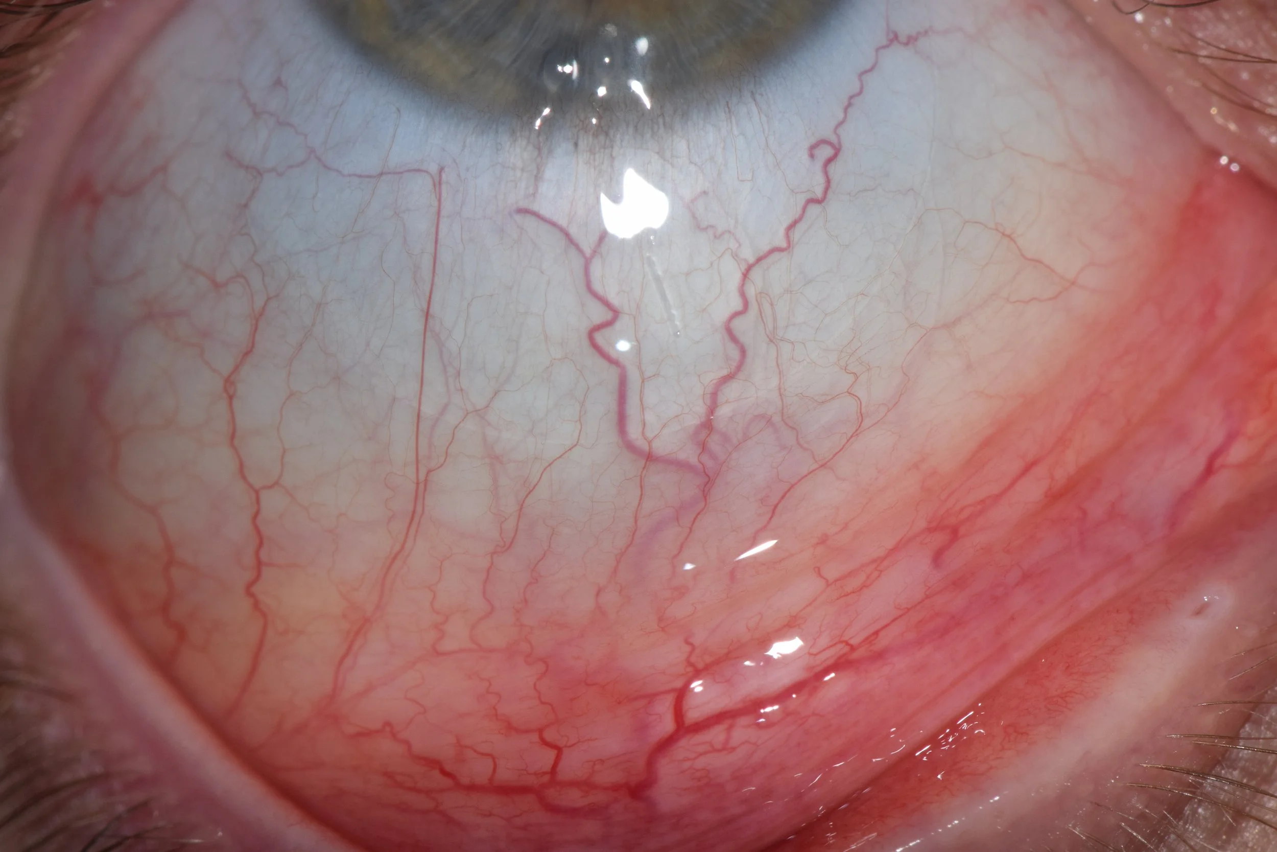 Sclera signs in the Lower Quadrant
