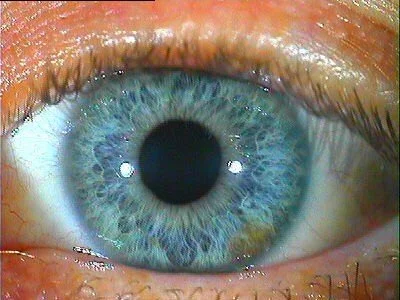 Iris example illustrating an atonic collarette, described in the article as the “open book” pattern.