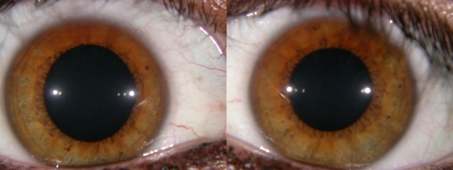 Eye illustrating mydriasis, with a large pupil relative to the surrounding iris.