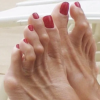 hammertoes.jpg