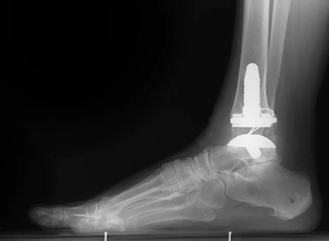 ankle-surgery-replacement2.jpg