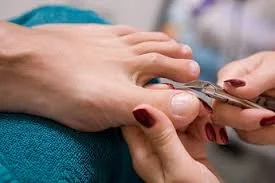 ingrown-toenail2.jpeg