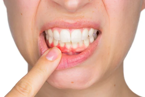 Gum Recession.jpg